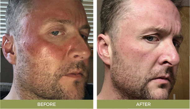 Before After Img