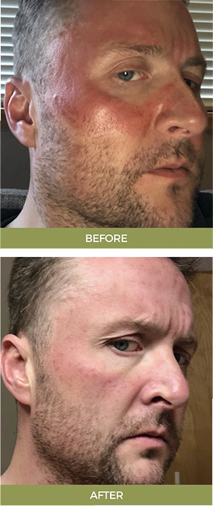 Before After Img